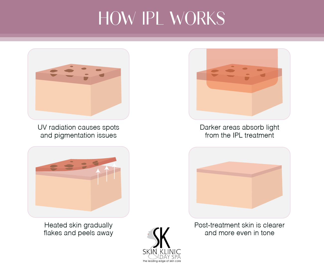 See how spots react to IPL at Rockland, Maine&rsquo;s Skin Klinic Med Spa.